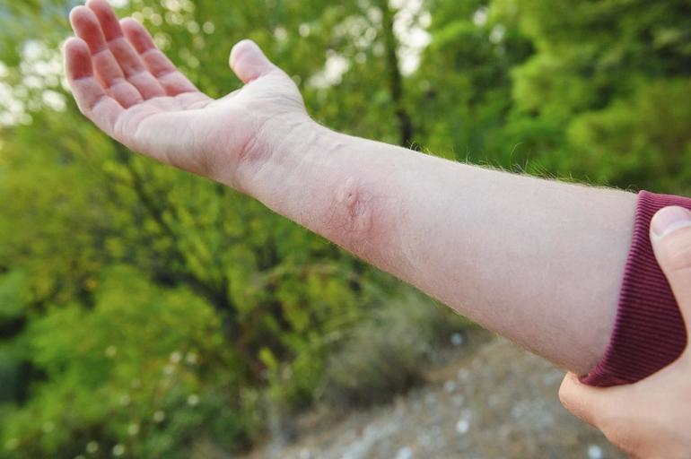 Después de la picadura de avispa