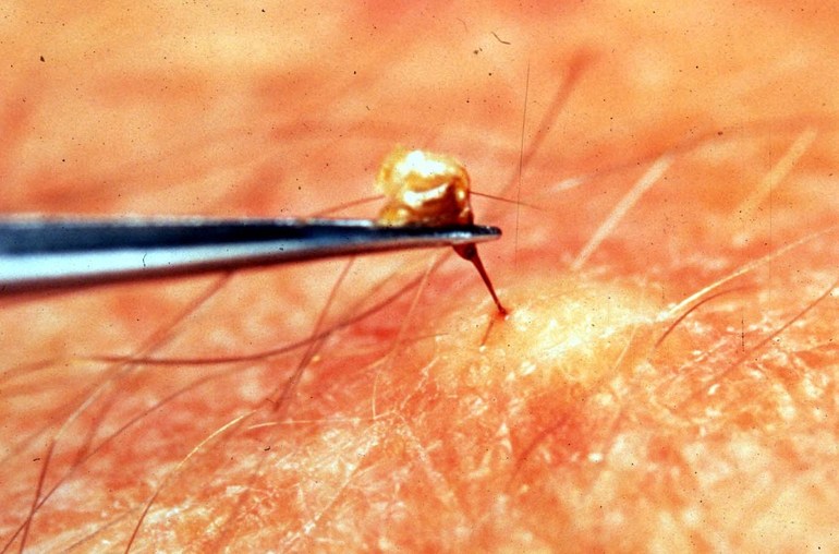 Saque el ovipositor de avispa