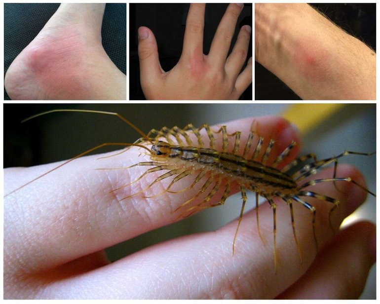 Mordida de atrapamoscas