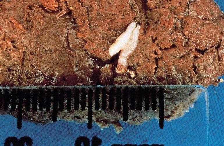 Si se encuentran manchas blancas en las heces